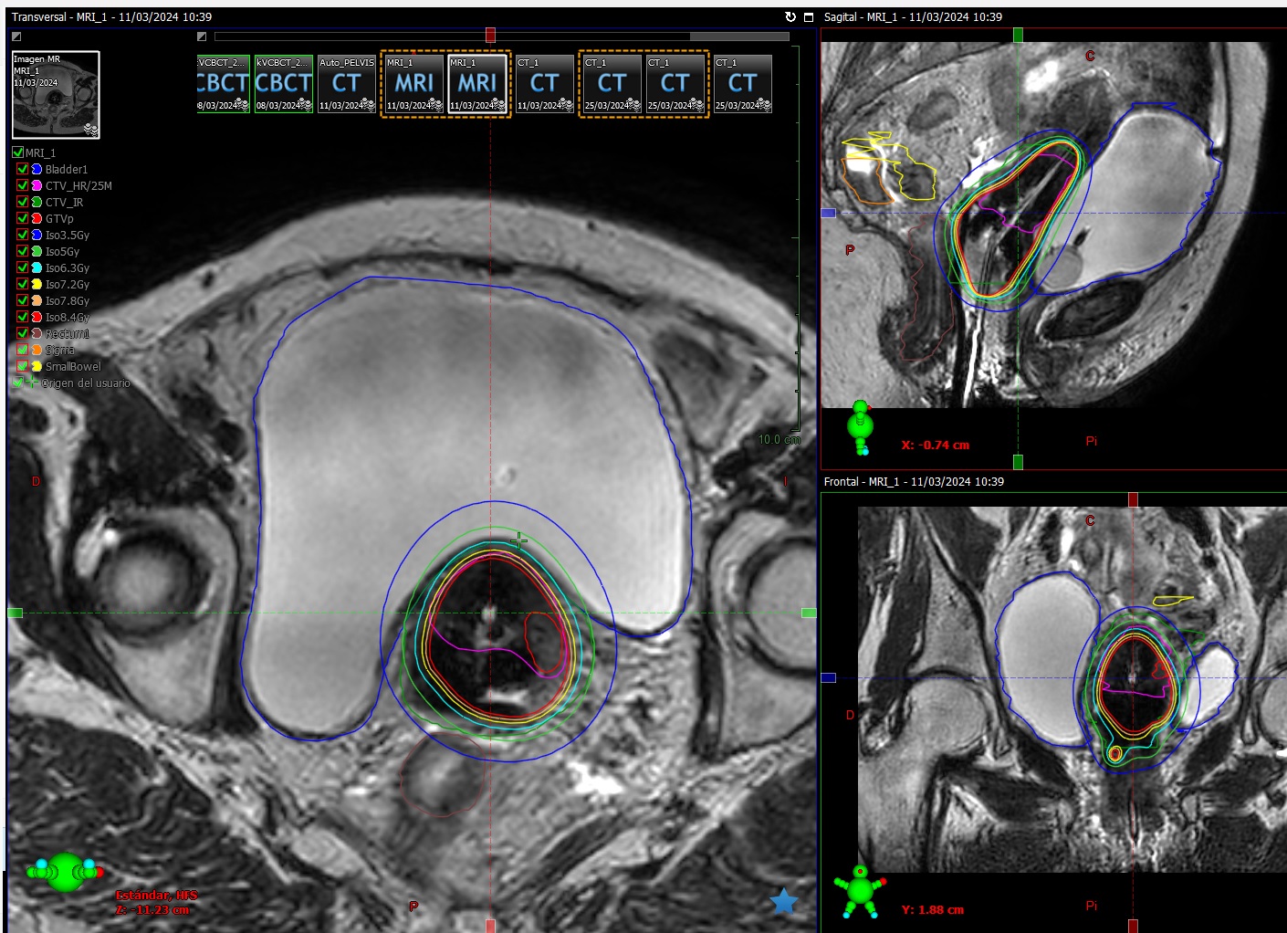 Braqui_cérvix_MRI.jpg
