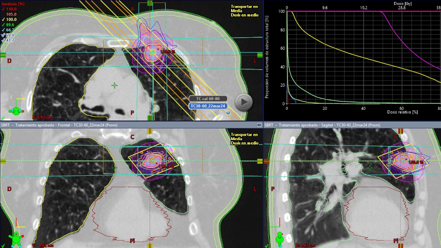 Visor Radioterapia2